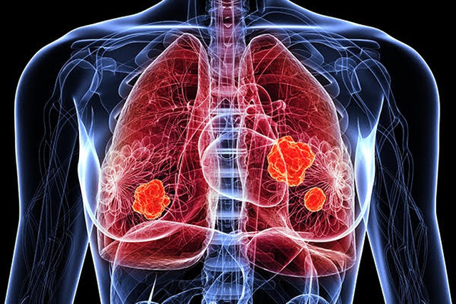 Ung thư phổi có nên ăn yến chưng không?